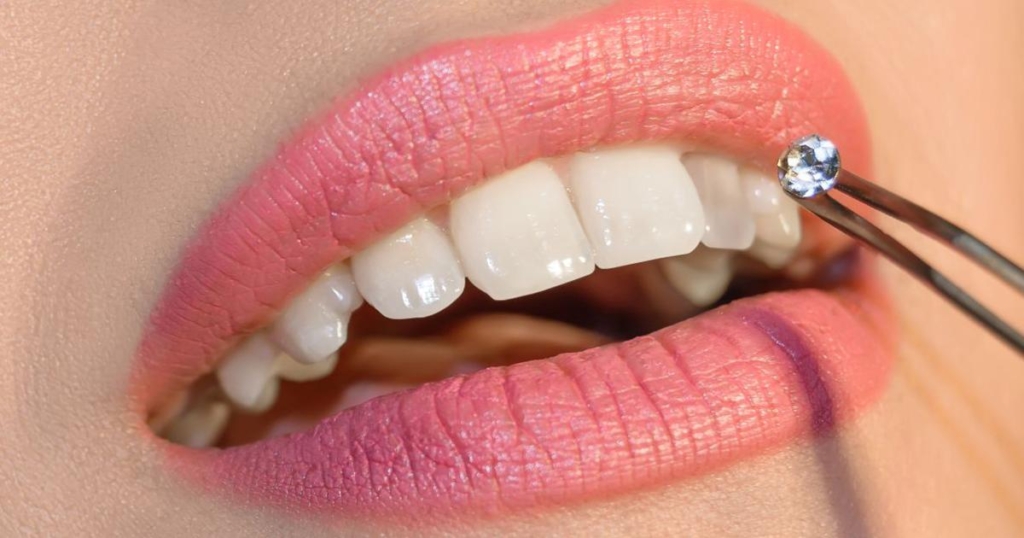 Bijuterie dentara | DentExpert ©