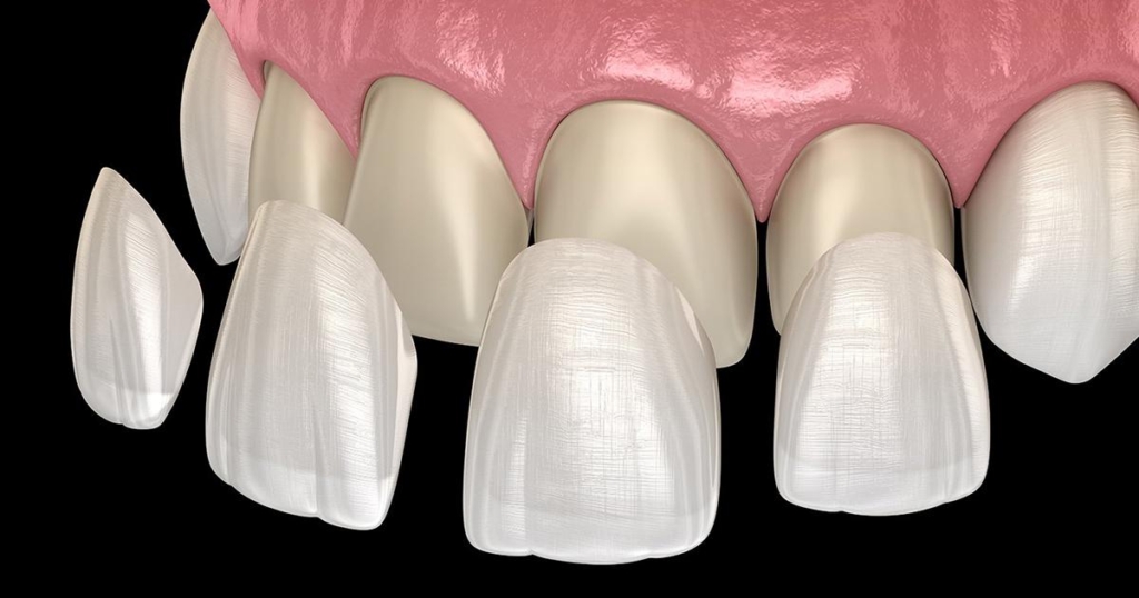 Estetica dentara fatete dentare | DentExpert ©