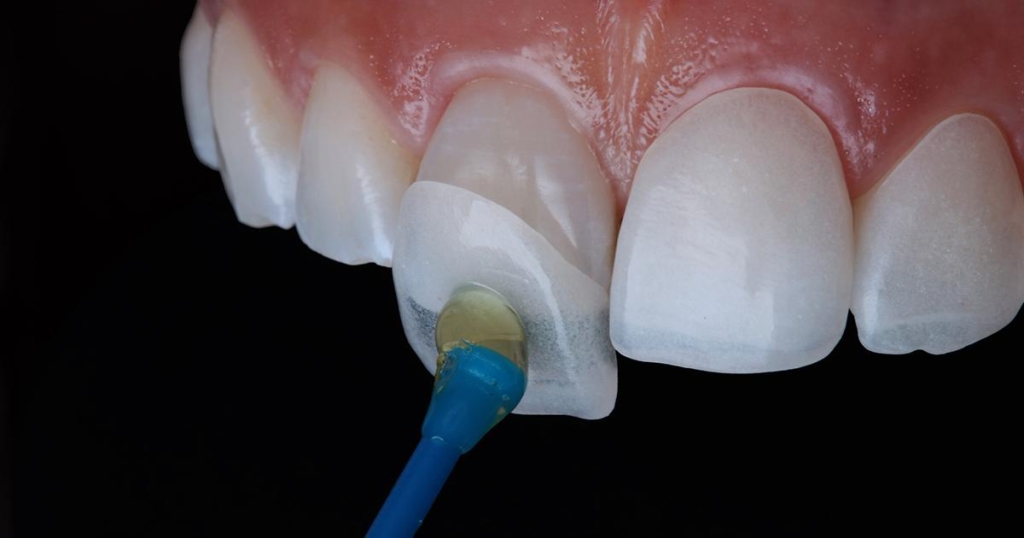 Fatete dentare | DentExpert ©