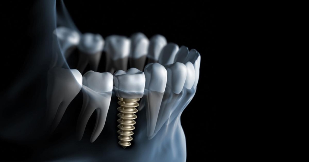 Implant simplu | DentExpert ©