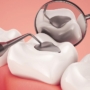 Care sunt diferențele dintre încrustație și plomba dentară?