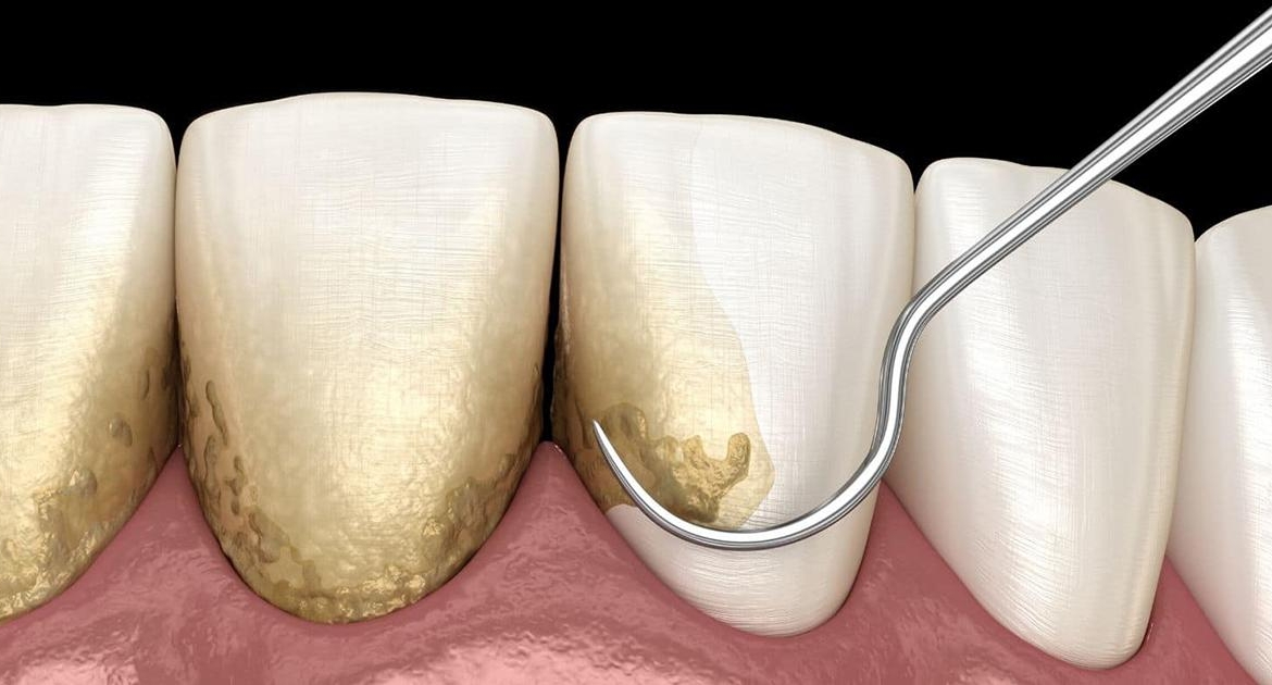Profilassi dentale
