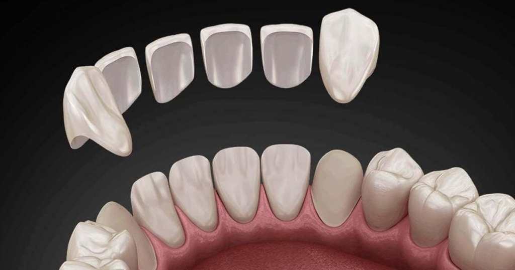Restaurare dentara | DentExpert ©
